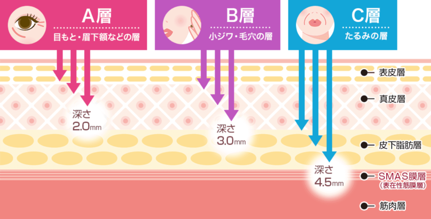 Non-Surgical Lift-Up Treatment: The Effects and Before-and-After Case Studies of the Recently Popular "Sonoclearing"!にて紹介している画像